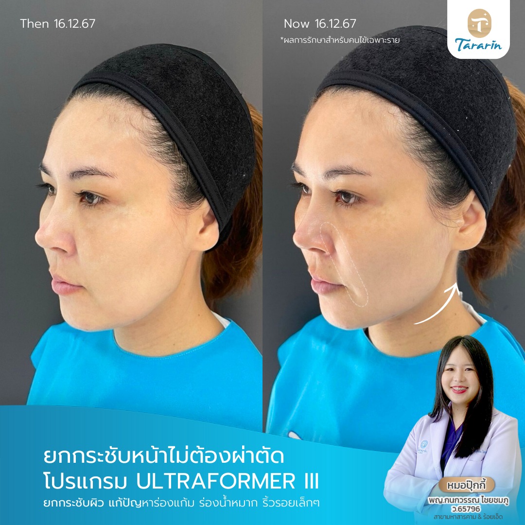 รีวิวผลลัพธ์ HIFU ยกกระชับและโบลดกราม